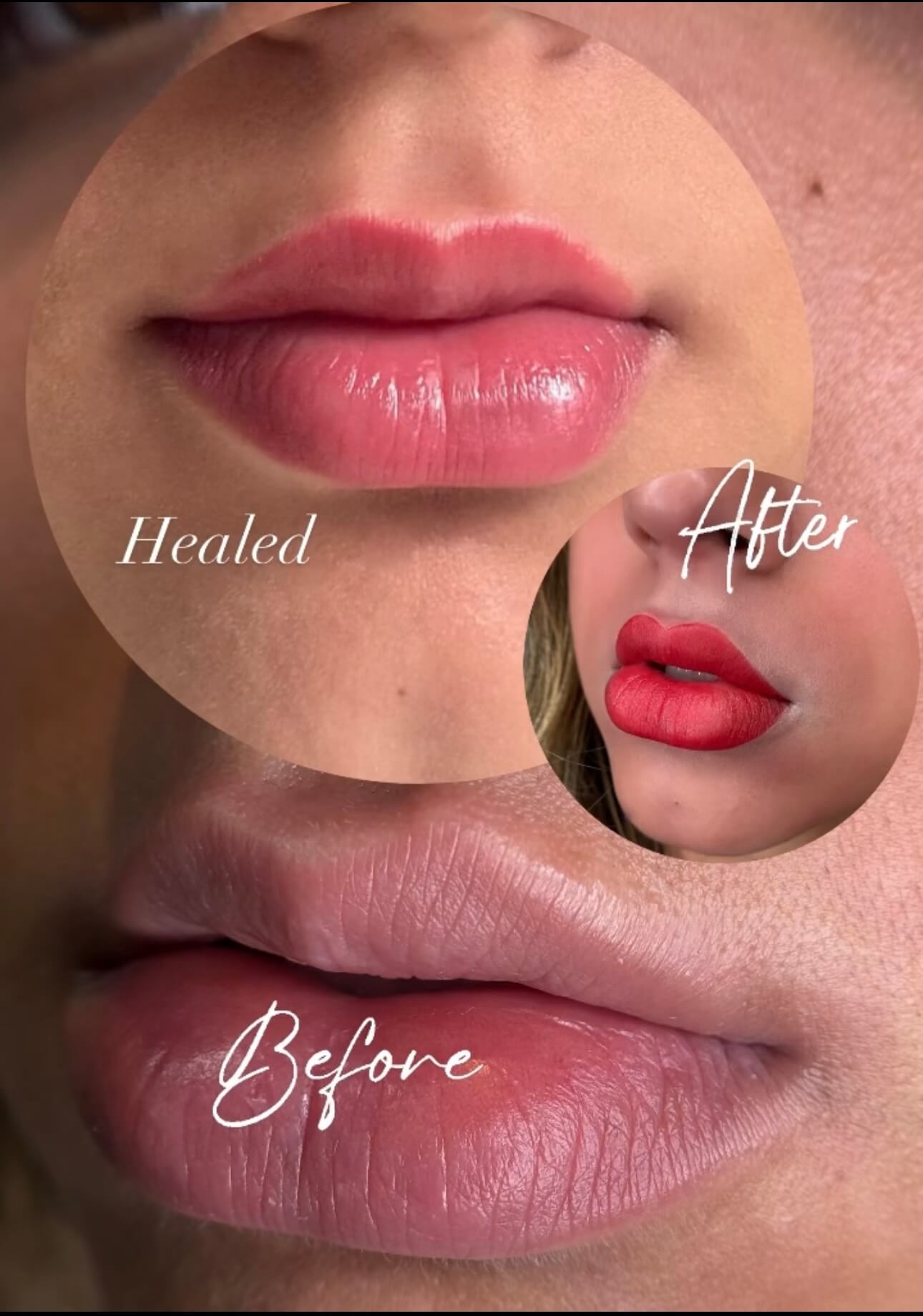 Diamond Lips Stage 3