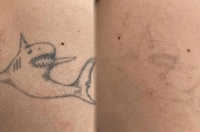 Tattoo removal