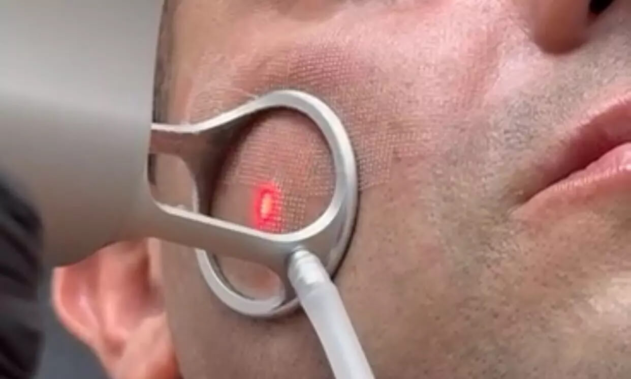 CO2 Resurfacing in Deefield Beach