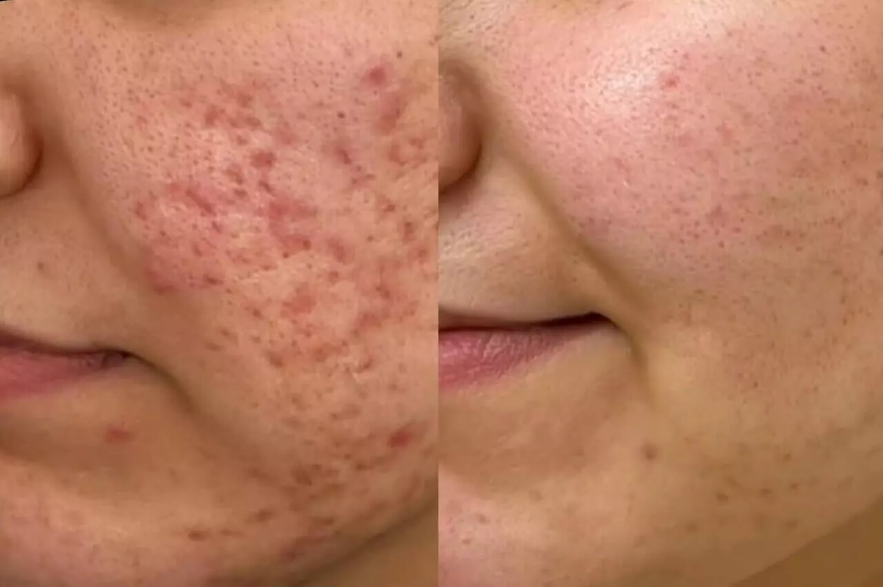 Before After Laser Scar Removal in Deerfield Beach