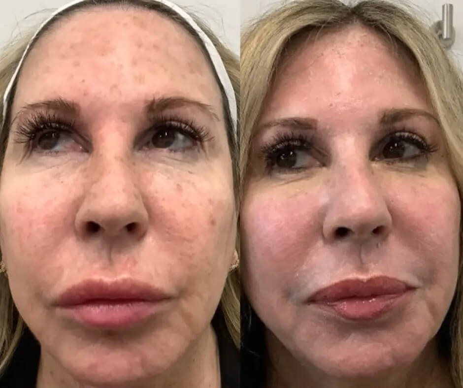 Skin Rejuvenation