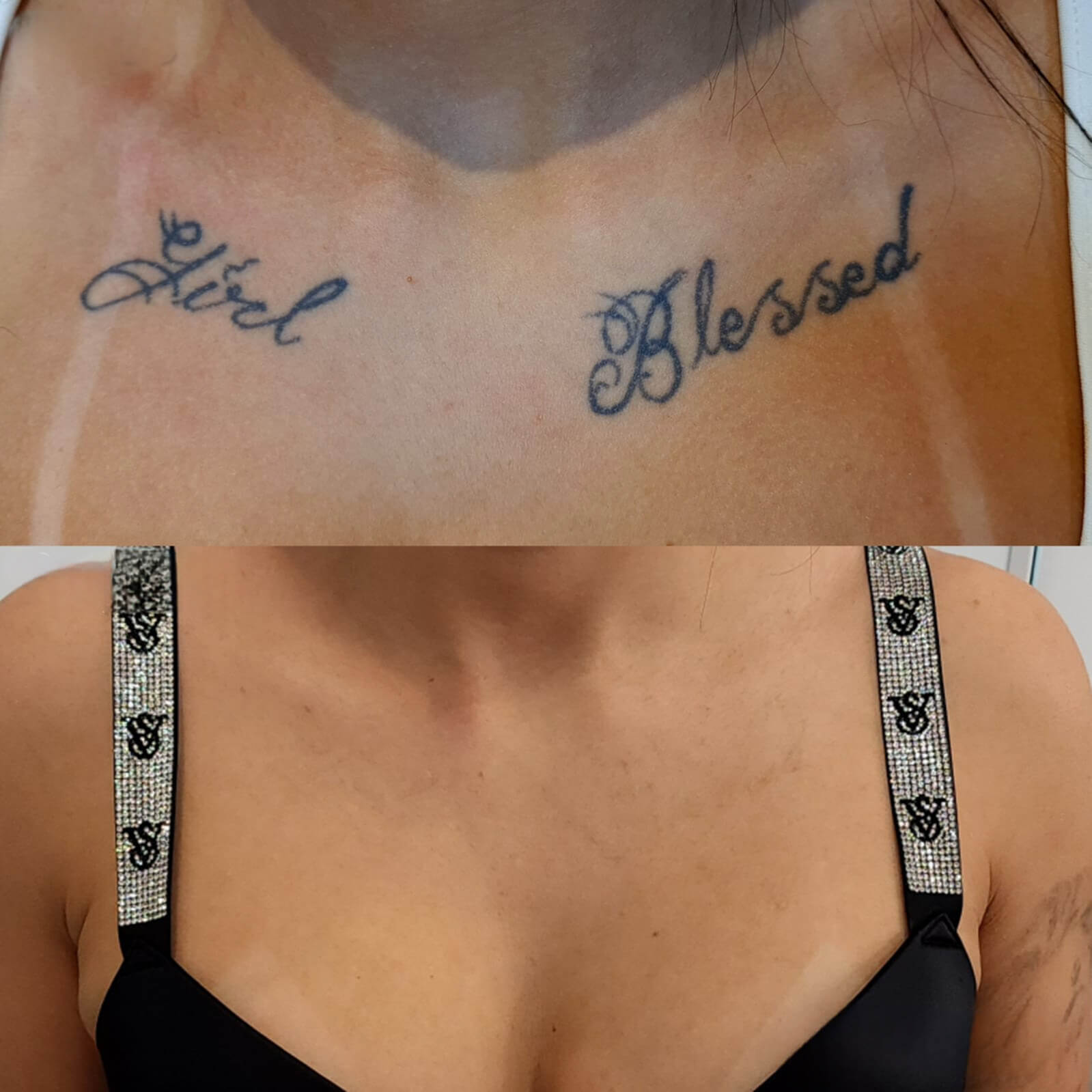 Laser Tattoo Removal