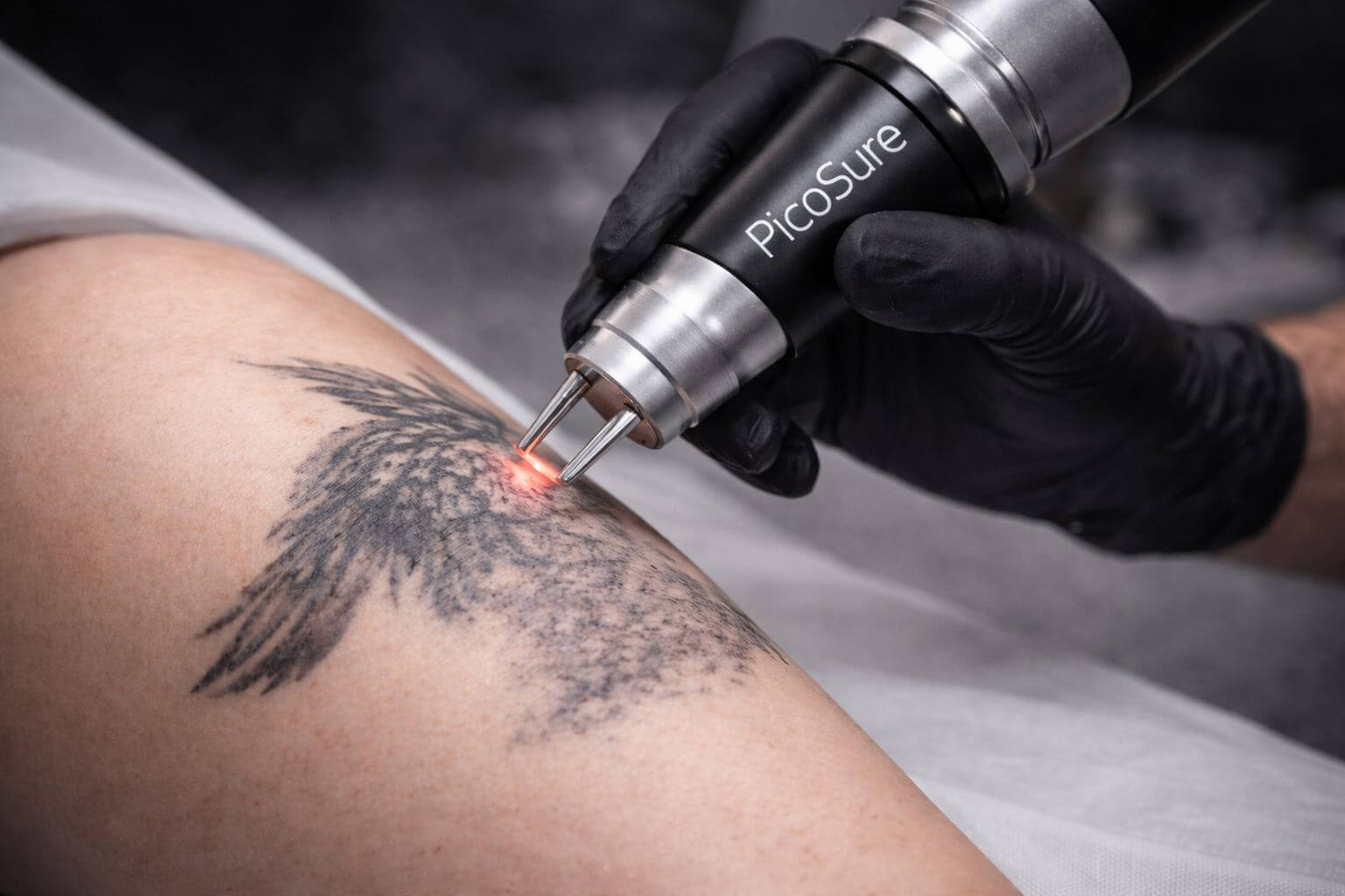Removing Tattoo with Laser